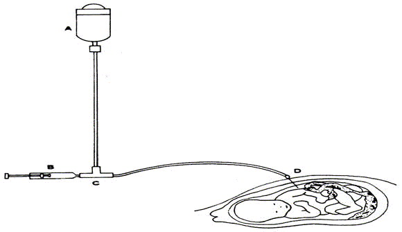 Amnioinfusion echosonic fetocare